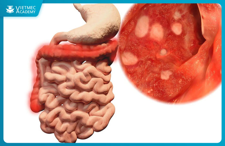 Bệnh Crohn có thể gây ra hiện tượng phù nề môi, nổi mề đay